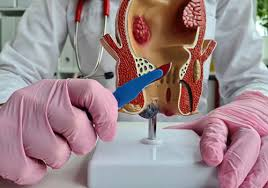 Doctor explaining Ksharsutra therapy to a patient