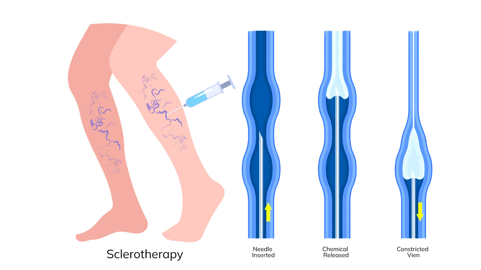 Doctor explaining sclerotherapy treatment to a piles patient